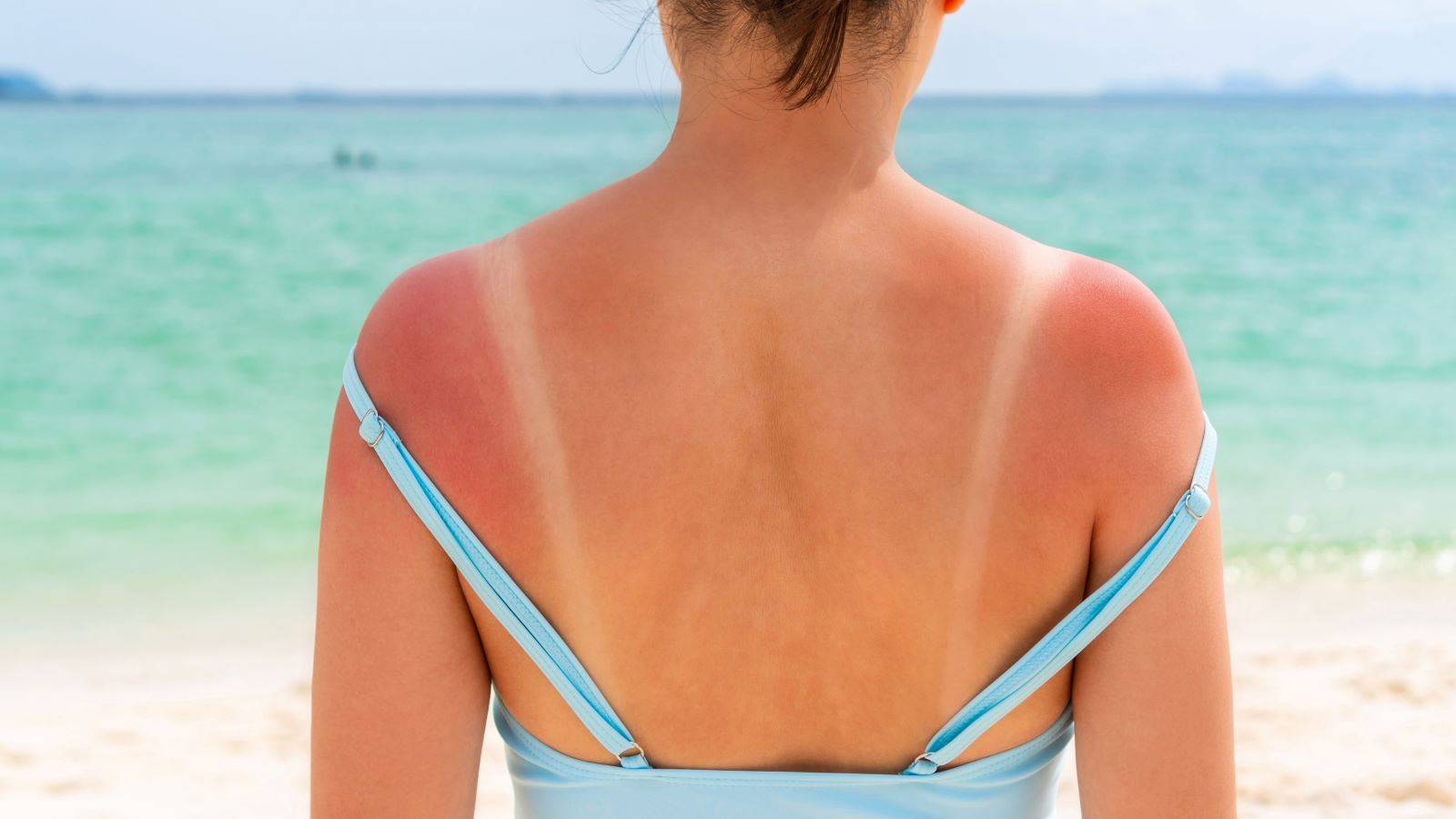 how to prevent sunburn